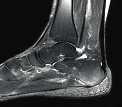 Entzündung der Plantarfaszie mit Knochenreizung.